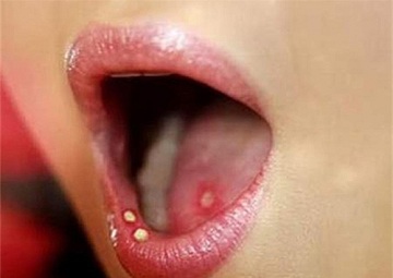Dấu hiệu bệnh giang mai ở miệng