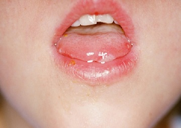 Nguyên nhân gây bệnh giang mai ở miệng