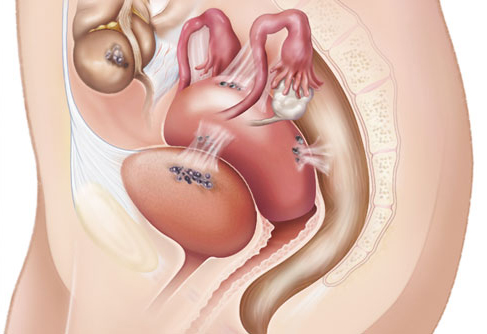 Bệnh viêm nội mạc tử cung