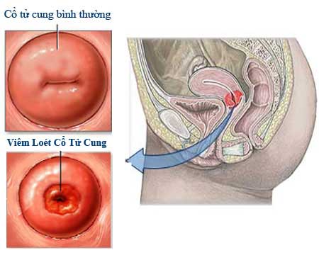 Cách điều trị bệnh viêm cổ tử cung