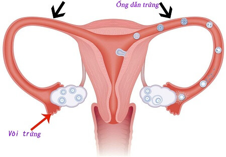 Nguyên nhân gây tắc vòi trứng ở phụ nữ