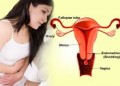 Bệnh viêm cổ tử cung là gì ? 